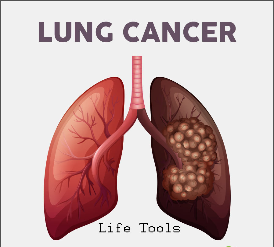 LUNG CANCER Guide ,New Treatments and Prevention